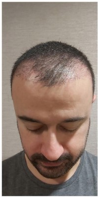 Before treatment