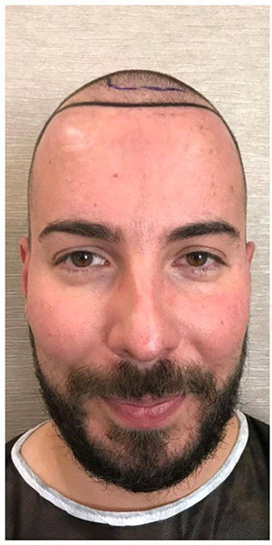 Before treatment