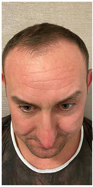 Before treatment