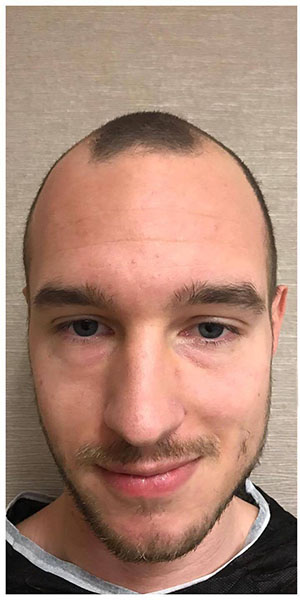 Before treatment