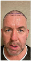 Before treatment