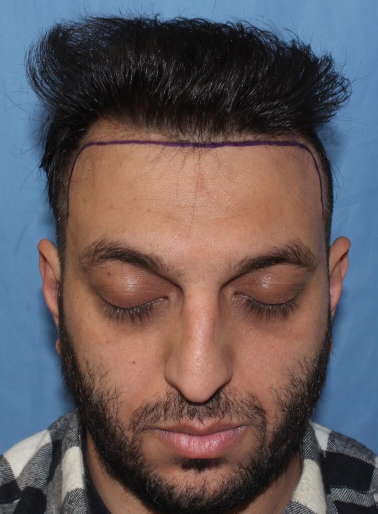 Before treatment
