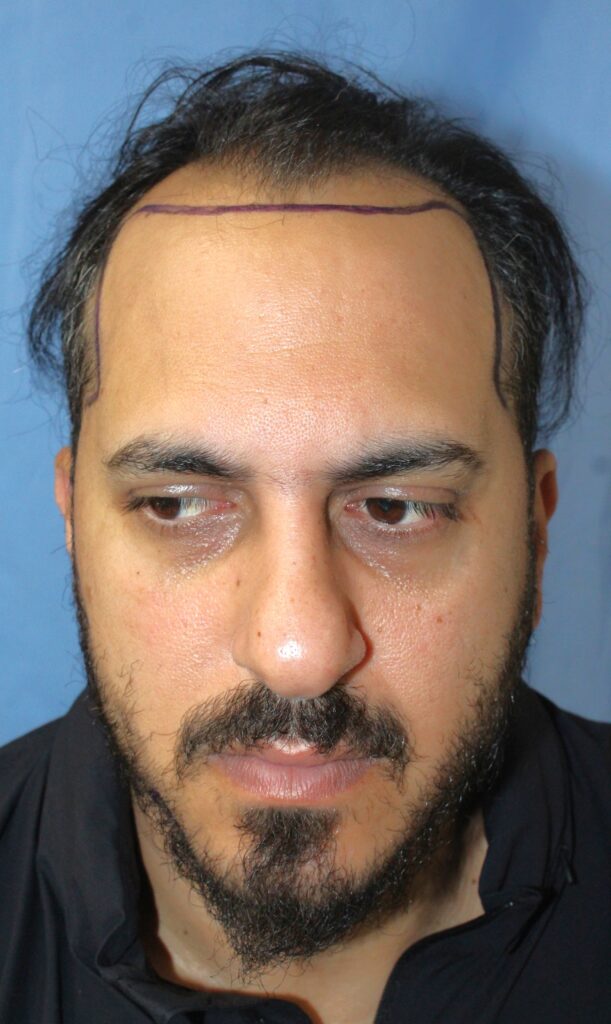 Before treatment