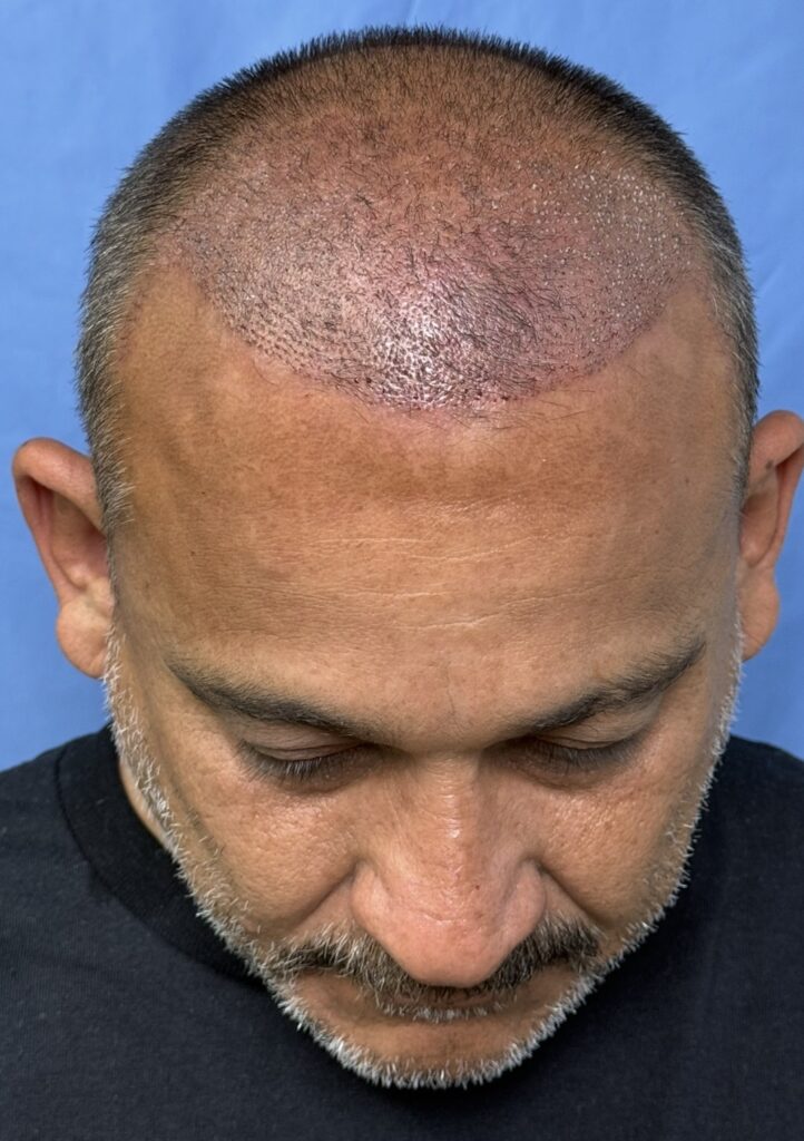 Before treatment