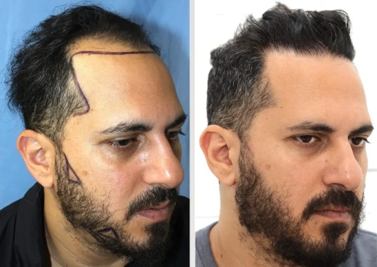 Hairline and beard restoration before and after