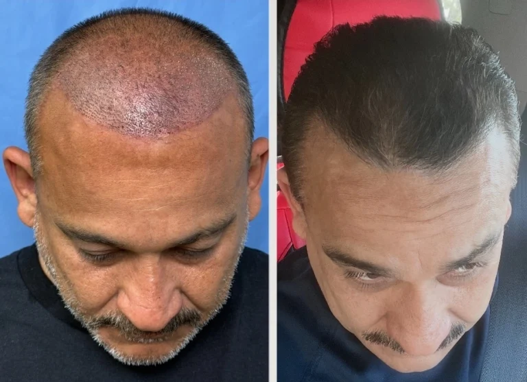 Hair transplant before and after result