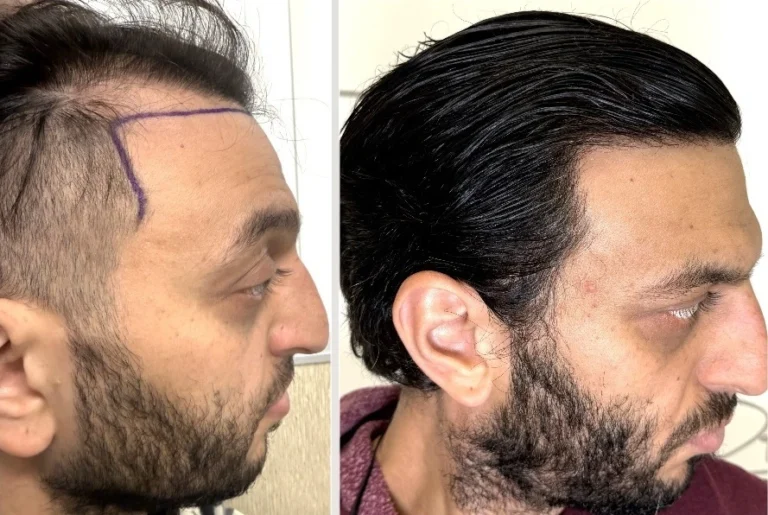 Hairline restoration before and after result